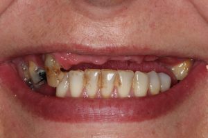 All-on-4® MALO CLINIC