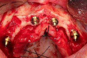 All-on-4® MALO CLINIC