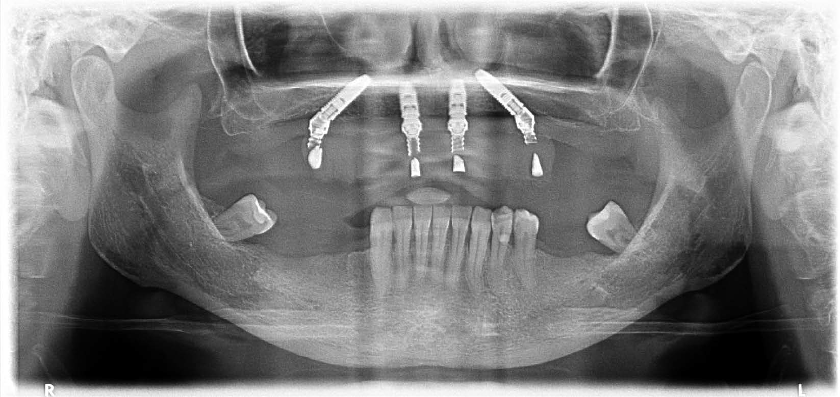 All-on-4® MALO CLINIC