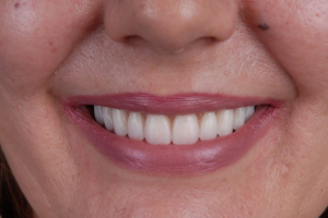 All-on-4® MALO CLINIC